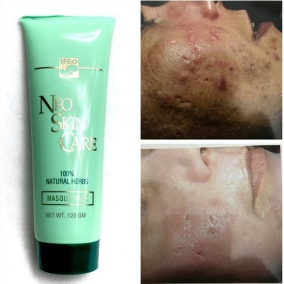 NEW BEST NATURAL HERBS MASK FOR ACNE & PROBLEM - Picture 7 of 7